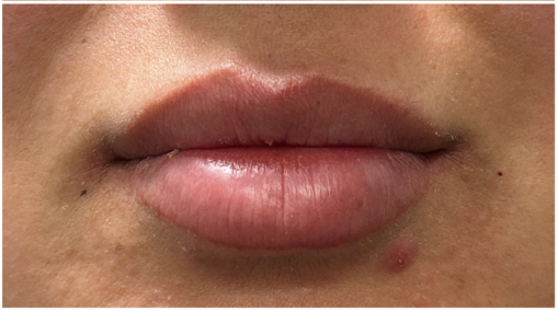 Lip Filler after — Thin Lips, front view