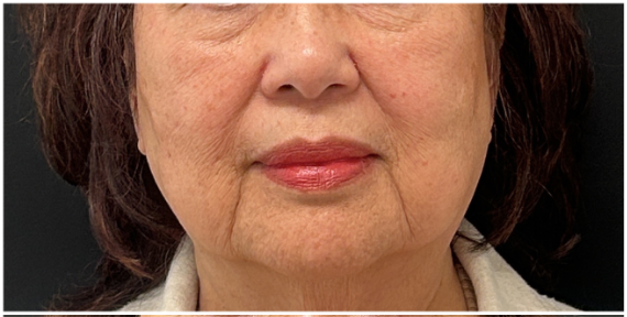 CO2 Laser Resurfacing before — Fine Lines and Wrinkles, Sagging and Laxity, Sun Damage, front view