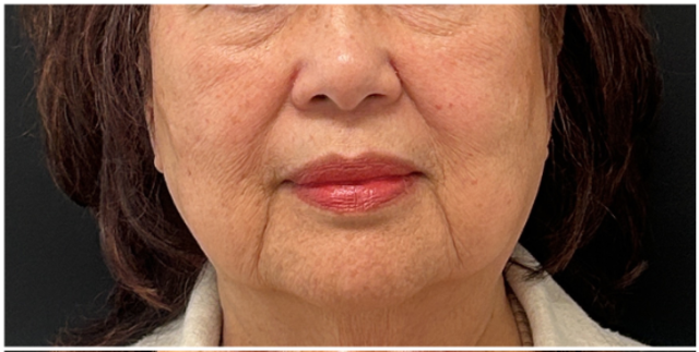 Laser Skin Resurfacing Before & After | CO2 for Fine Lines and Skin Tightening — before
