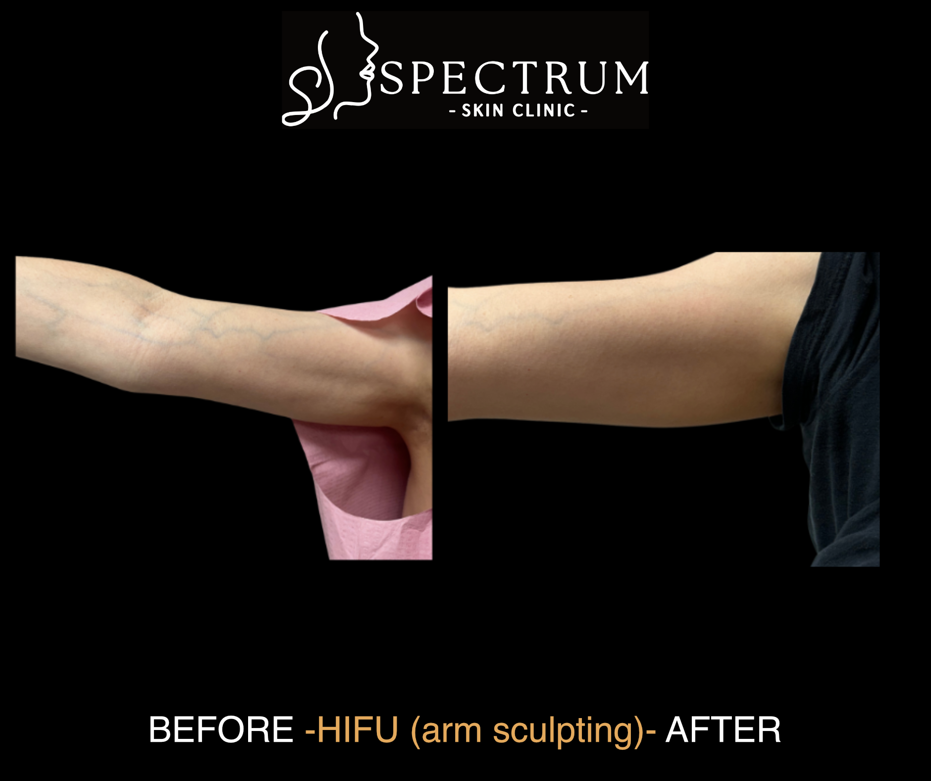 HIFU Arm Sculpting Before & After | Upper Arm Skin Tightening