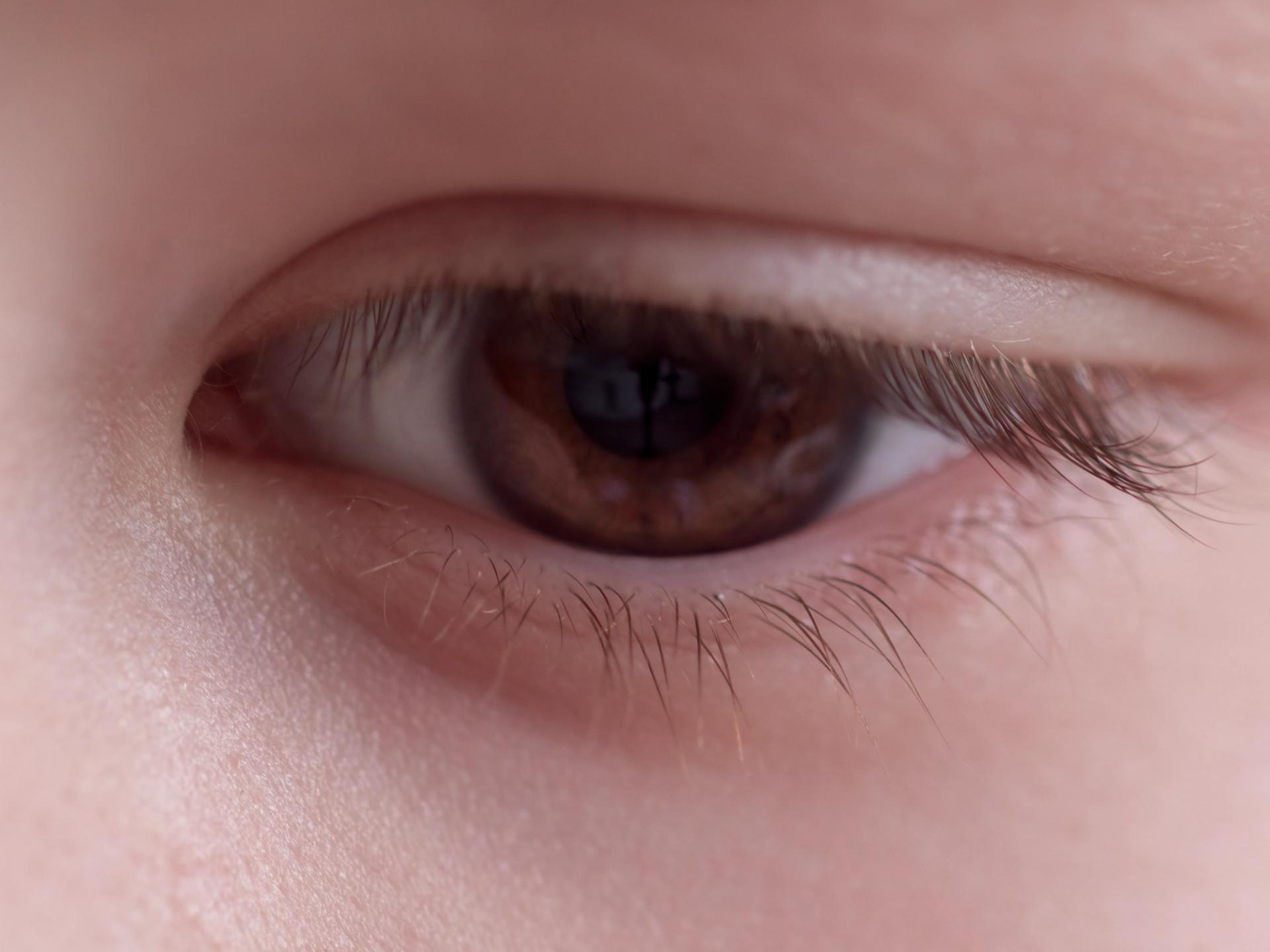 Fotona VectorLift Brow and Eyelid Lift in Irvine, CA performed by Dr. Sabeen Munib, MD