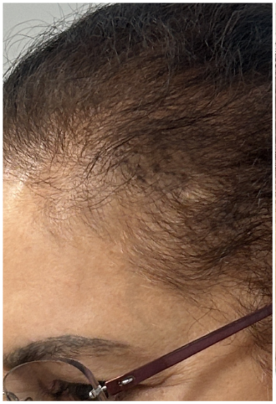 Exosome Therapy before — Hair Thinning at Temples Female, Temporal Hairline Thinning, front view