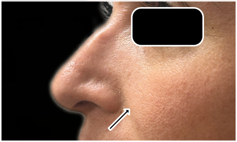 Under Eye Filler Dissolve after — Under Eye Hollows, Filler Migration, Tear Trough Migration, front view