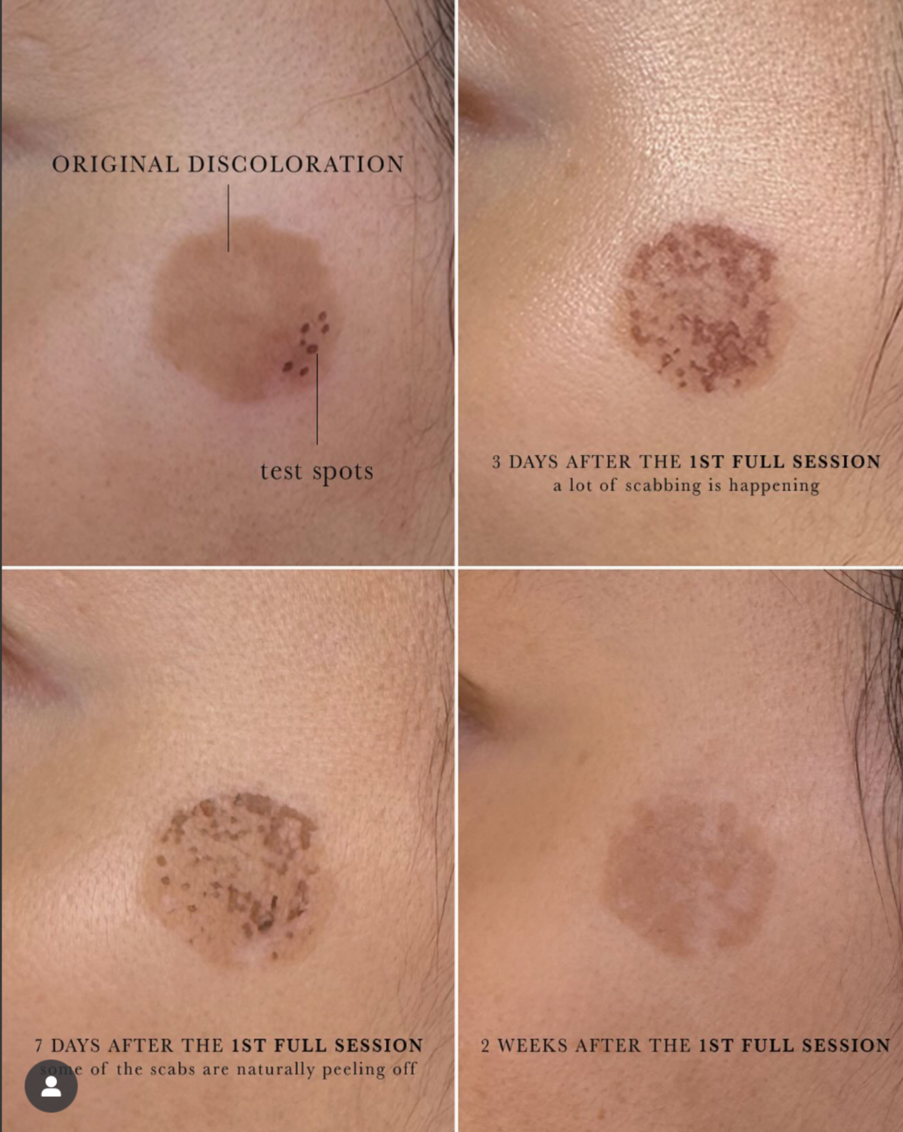 Q-Switch ND:YAG Laser for Sun Spots after — Sun Spots, Hyperpigmentation, Photodamage, front view