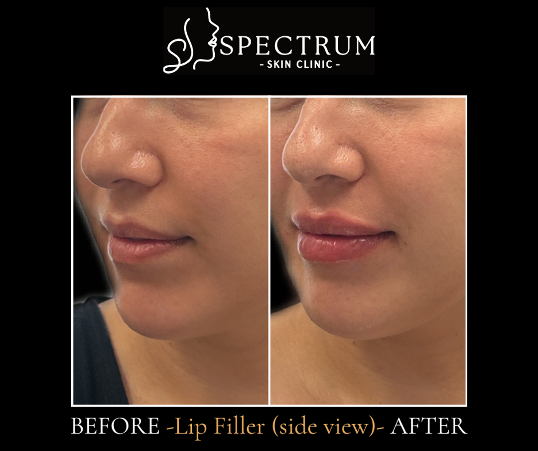 Lip Filler Before & After (Side View) | Natural Projection & Shape