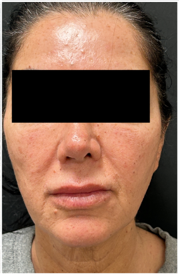 Cheek Filler, Facial Balancing after — Midface Volume Loss, Sagging and Laxity, Nasolabial Folds, Lower Face Sagging, front view
