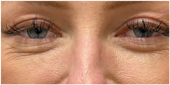 Filler Dissolve before — Under Eye Hollows, Under Eye Bags and Puffiness, Filler Migration, front view