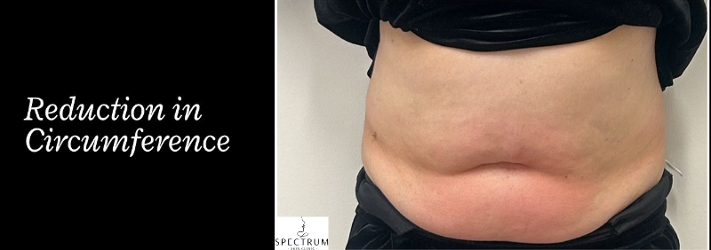 Body Cavitation before — Localized Fat, Body Contouring, Thigh Fat, Hip Fat, front view