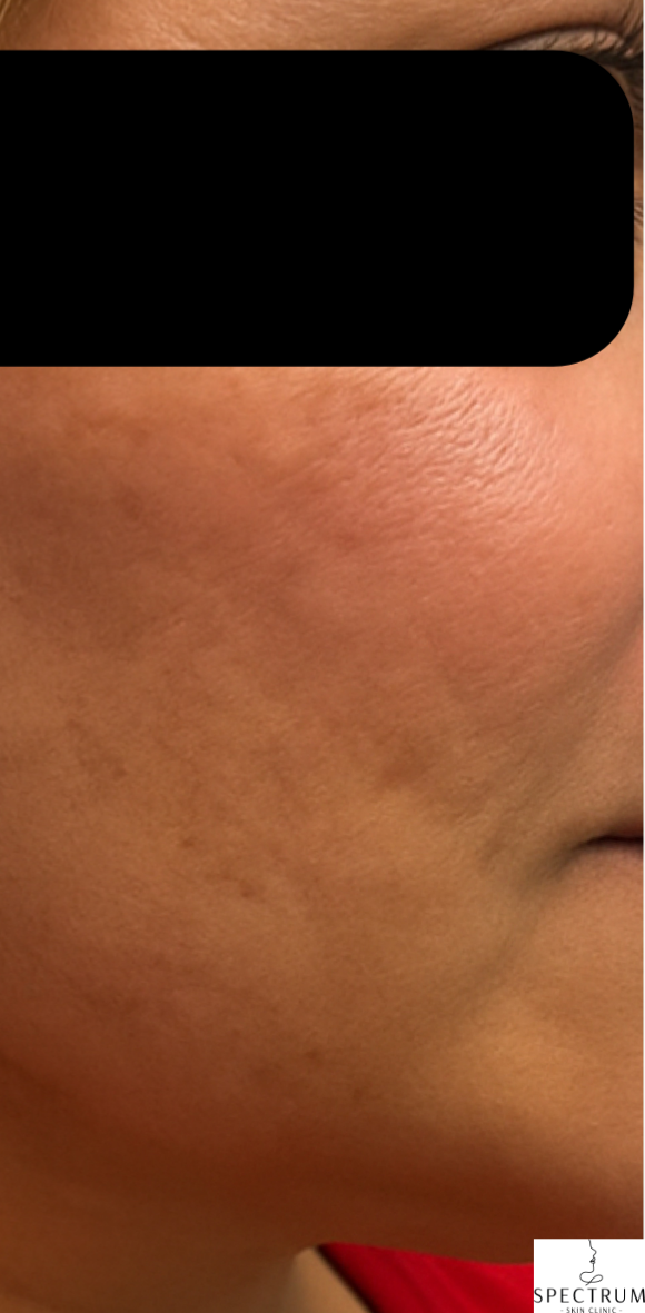 RF Microneedling, TCA CROSS Peel after — Acne Scars, Uneven Texture, Boxcar Scars, Rolling Scars, front view