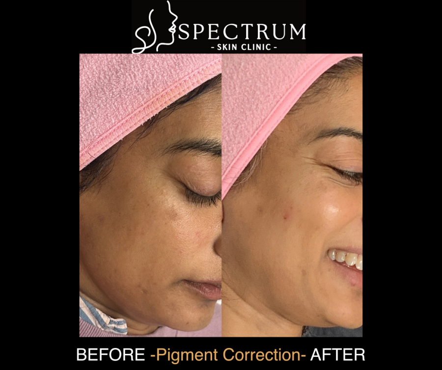 Chemical Peel Before and After | Facial Pigment Correction