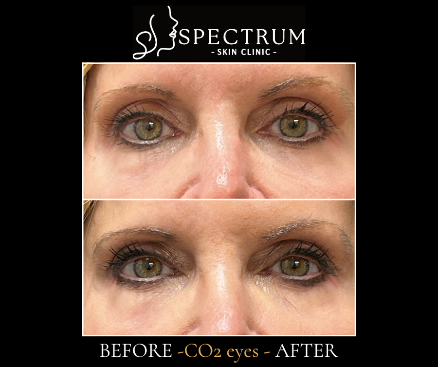 CO2 Laser Resurfacing for Eyes Before & After | Fine Line and Texture Renewal
