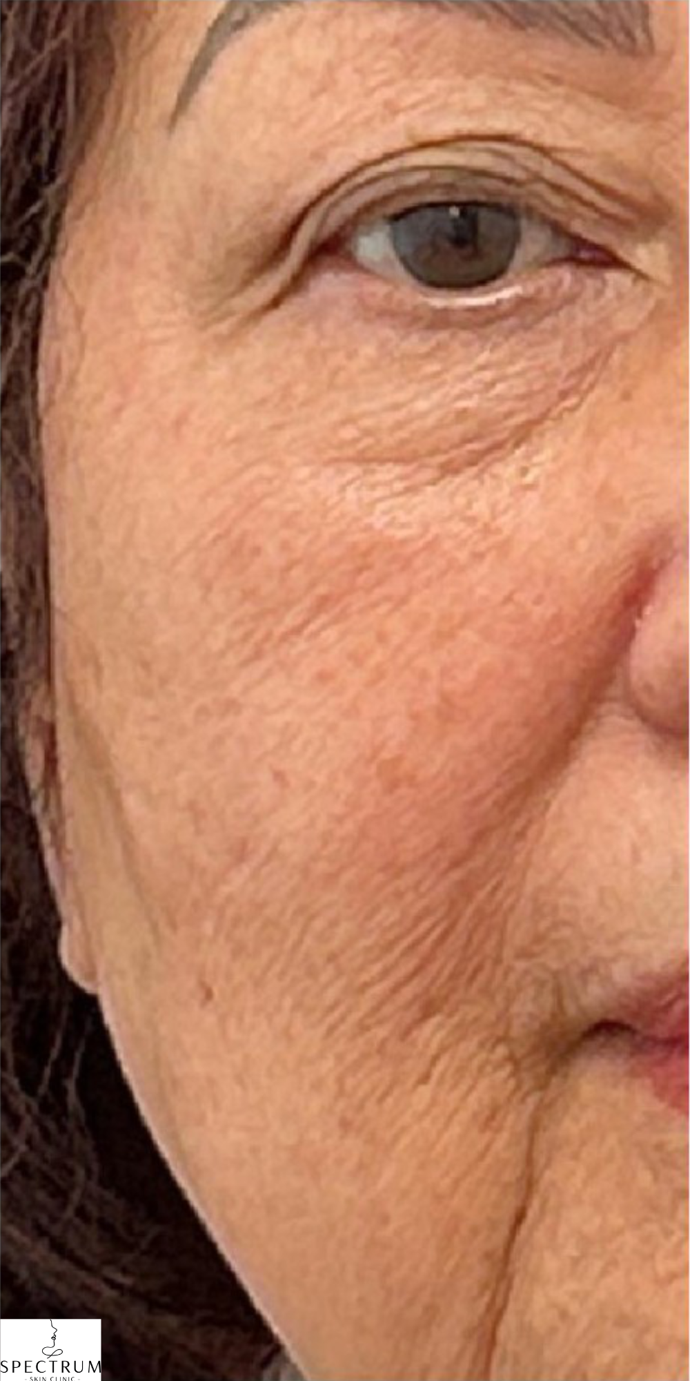 Secret PRO before — Uneven Texture, Fine Lines and Wrinkles, Skin Tone, front view