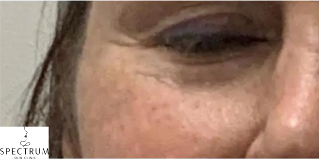 Filler Dissolve and Restoration before — Filler Migration, Distorted Midface, Over-Filled Cheeks, front view