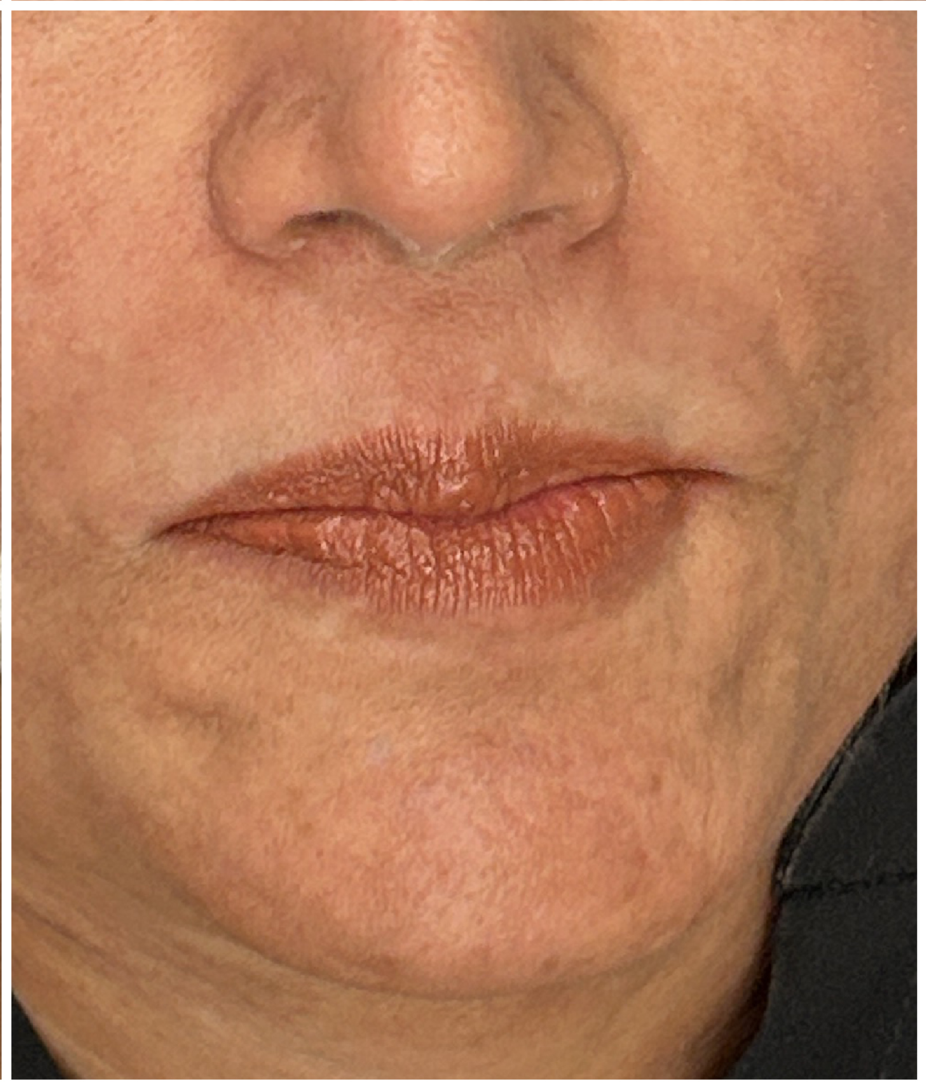 Chemical Peel for Pigment Correction after — Melasma, Hyperpigmentation, Sun Damage, front view