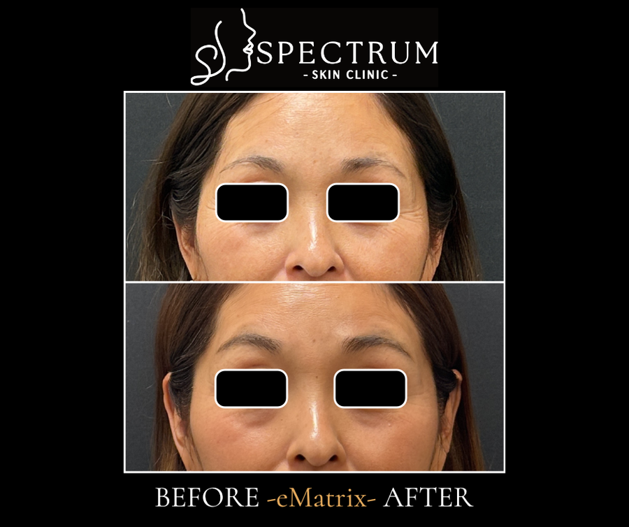 eMatrix Before and After, Full Face Skin Texture Improvement at Spectrum Skin Clinic, Irvine