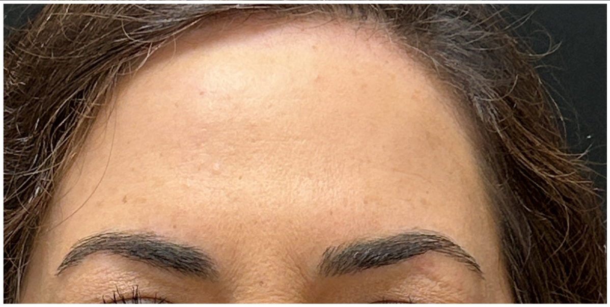 dysport before — fine-lines-wrinkles, front view
