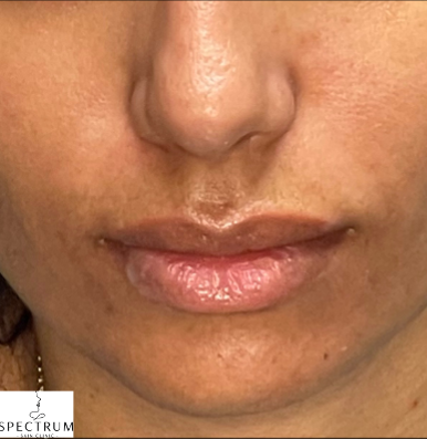 Lip Filler before — Thin Lips, front view
