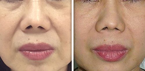 Fotona 4D Before and After | Non-Surgical Facial Tightening