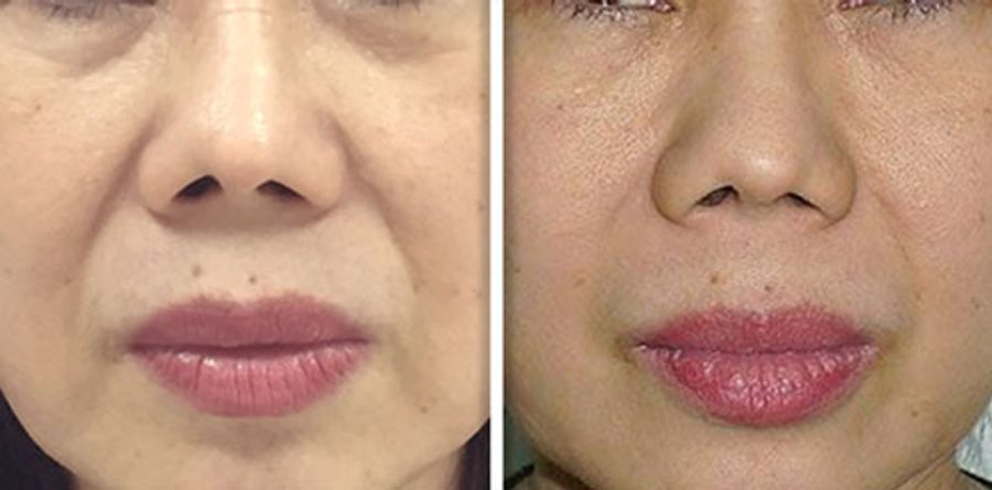 Fotona 4D Before and After | Non-Surgical Facial Tightening