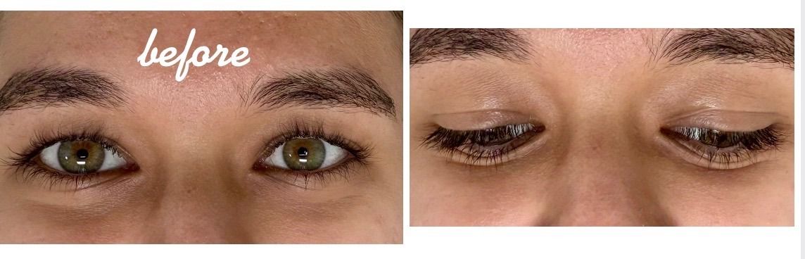 Lash Lift before — Straight Lashes, Downward-Pointing Lashes, Lashes Hidden Against the Lid, front view