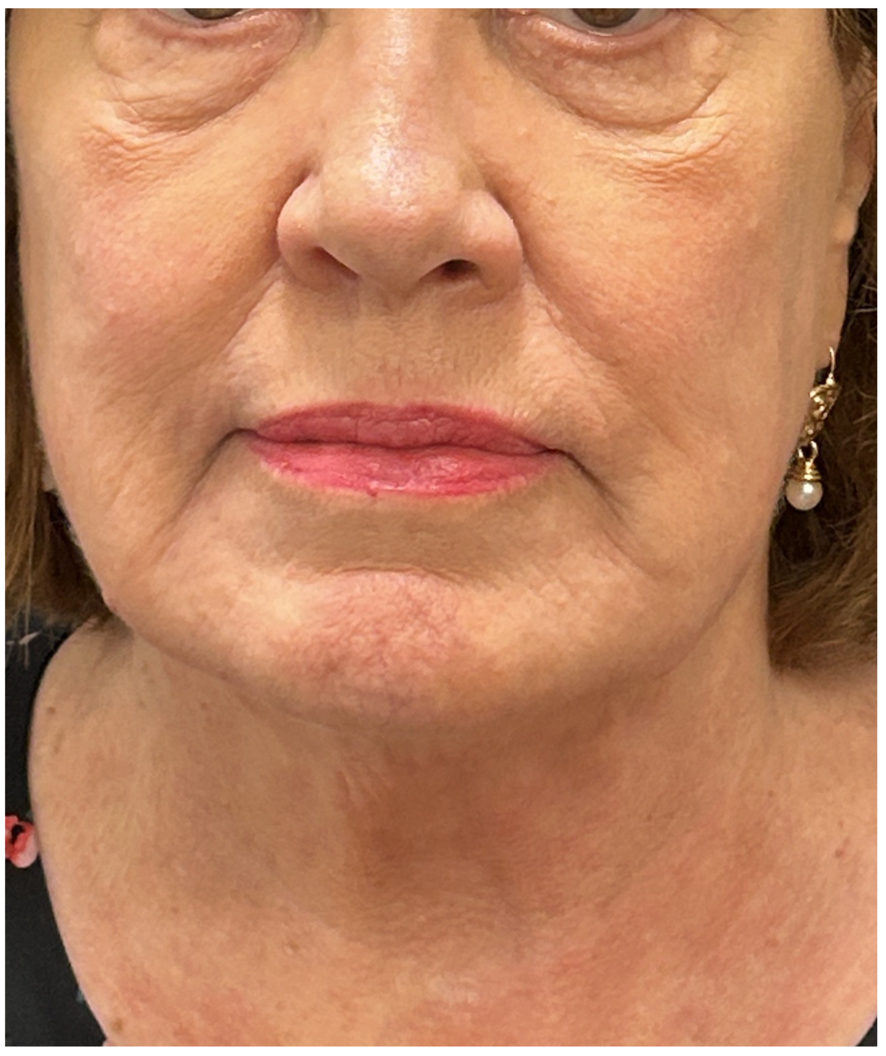 eMatrix Sublative RF Resurfacing after — Fine Lines and Wrinkles, Sagging and Laxity, Uneven Texture, front view
