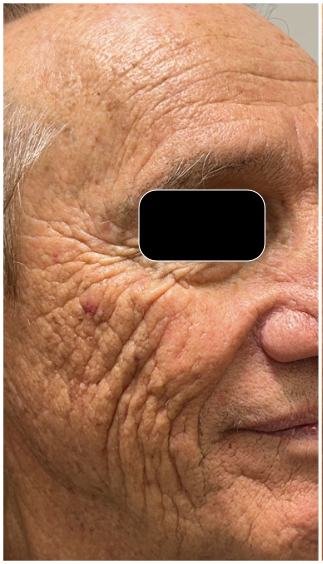 CO2 Laser Resurfacing before — Crow’s Feet, Periorbital Lines, Cheek Wrinkles, Uneven Texture, Photoaging, front view