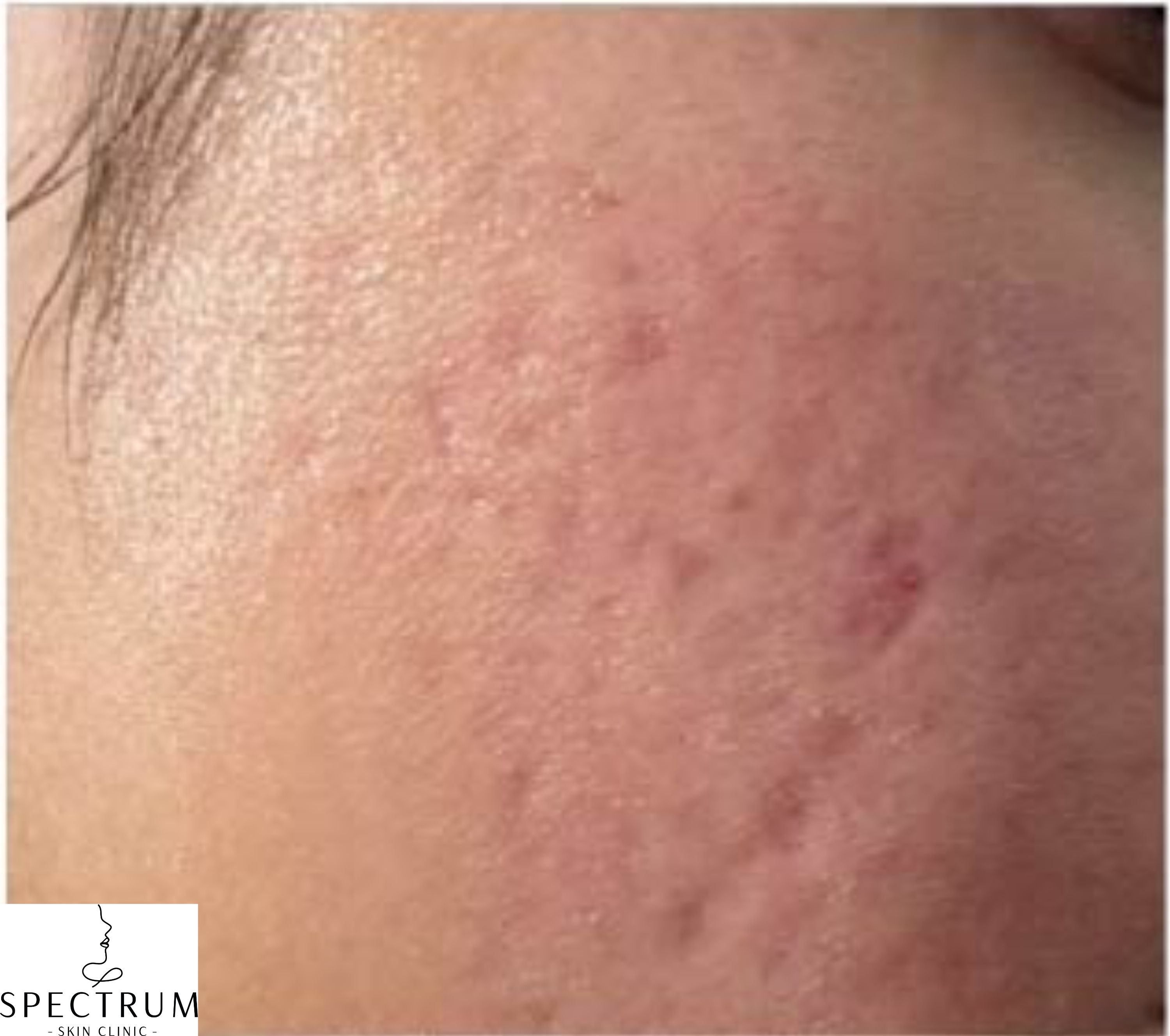 RF Microneedling, TCA CROSS Peel before — Acne Scars, Active Acne, Uneven Texture, front view