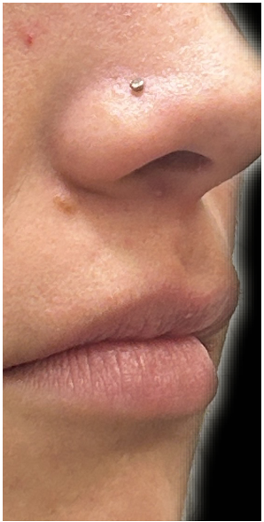 Lip Filler before — Thin Lips, front view