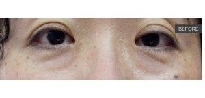 Laser Under-Eye Tightening before — , front view