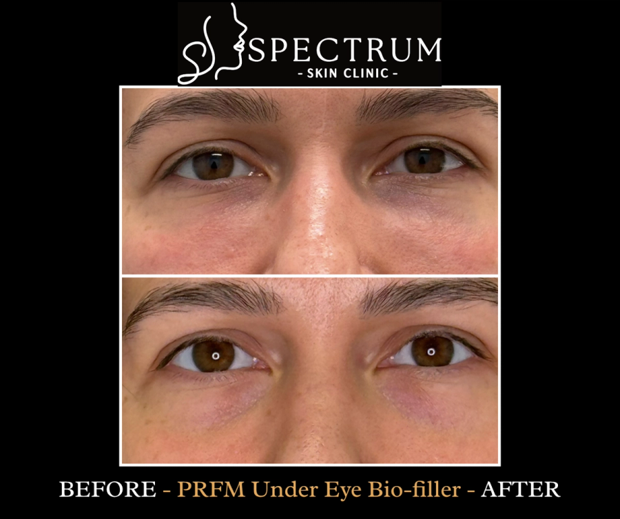 Under-eye skin quality treated with Selphyl PRFM. This is the presentation platelet treatment suits: thin, crepey skin rather than a true hollow.