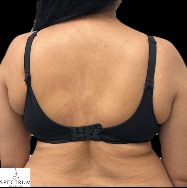 Body Cavitation after — Bra Bulge, Upper Back Fat, Body Contouring, Localized Fat, front view