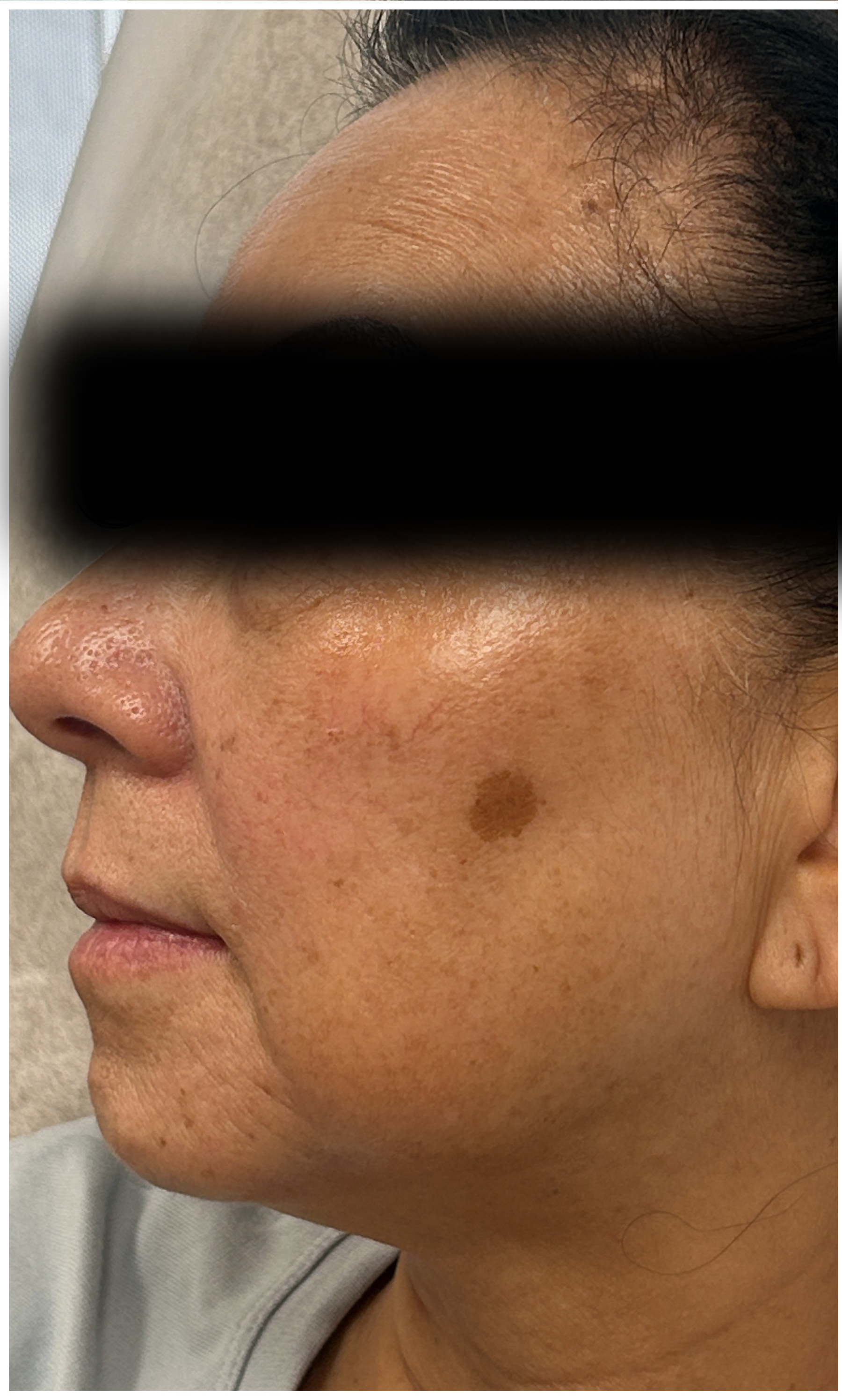 CO2 Laser Resurfacing before — Hyperpigmentation, Brown Spots, Sagging and Laxity, Uneven Texture, Sun Damage, front view