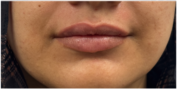 Lip Filler after — Thin Lips, front view