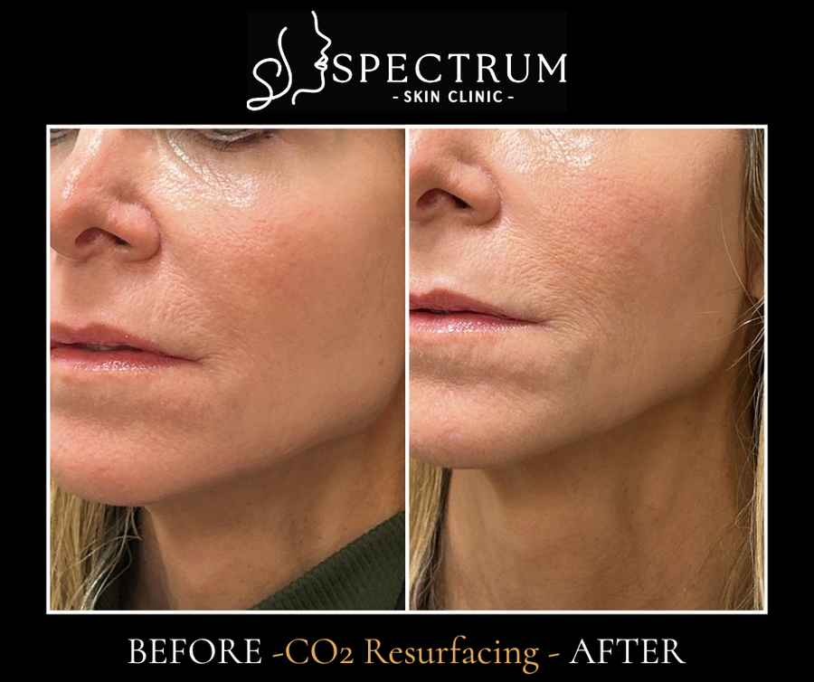 CO2 Laser Resurfacing Before & After | Skin Texture and Tone Renewal