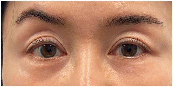 Filler Dissolve after — Under Eye Hollows, Filler Migration, Tear Trough Migration, front view