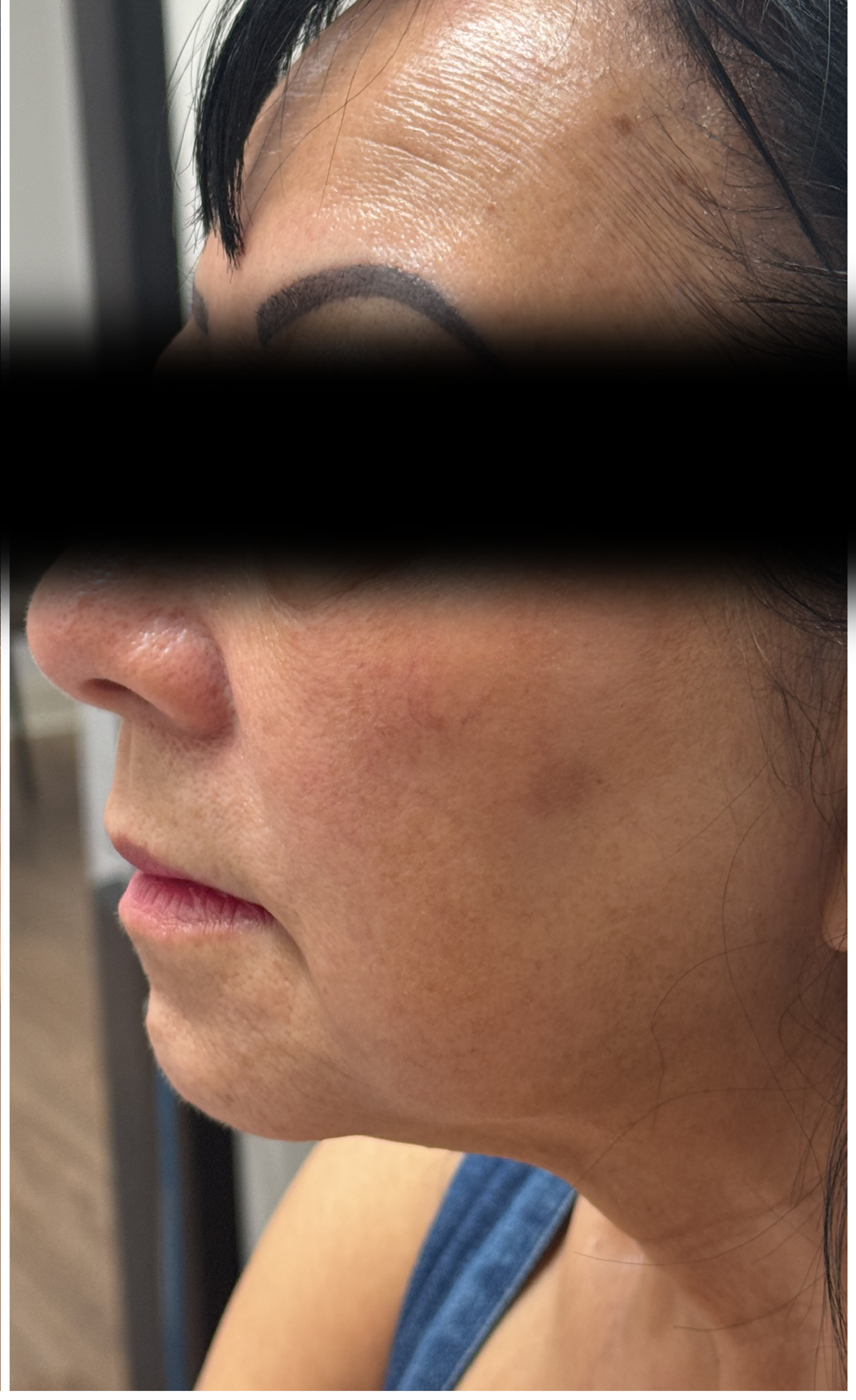 CO2 Laser Resurfacing after — Hyperpigmentation, Brown Spots, Sagging and Laxity, Uneven Texture, Sun Damage, front view