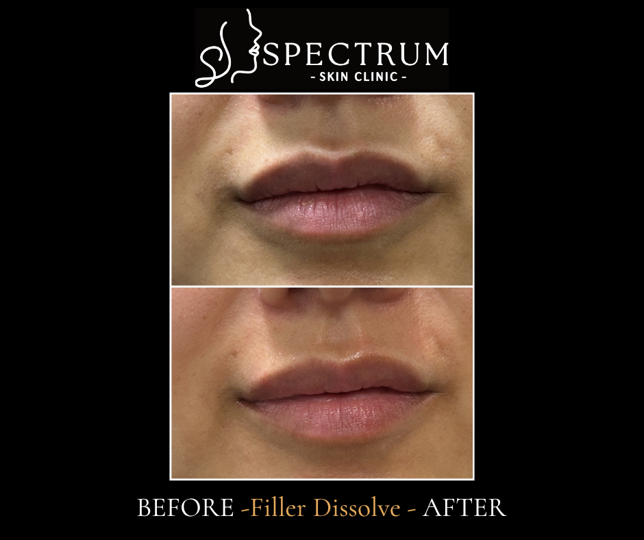 Lip Filler Dissolve – Front View (Migration Correction)
