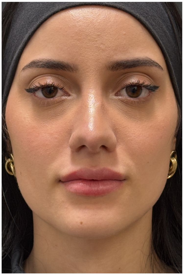 Lip Filler after — Lip Asymmetry, front view