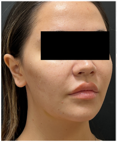 HIFU before — Sagging and Laxity, Lower Face Contour, Jawline Definition, Skin Tightening, front view