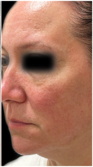 IPL Photofacial after — Facial Redness, Hyperpigmentation, Uneven Skin Tone, Sun Damage, front view