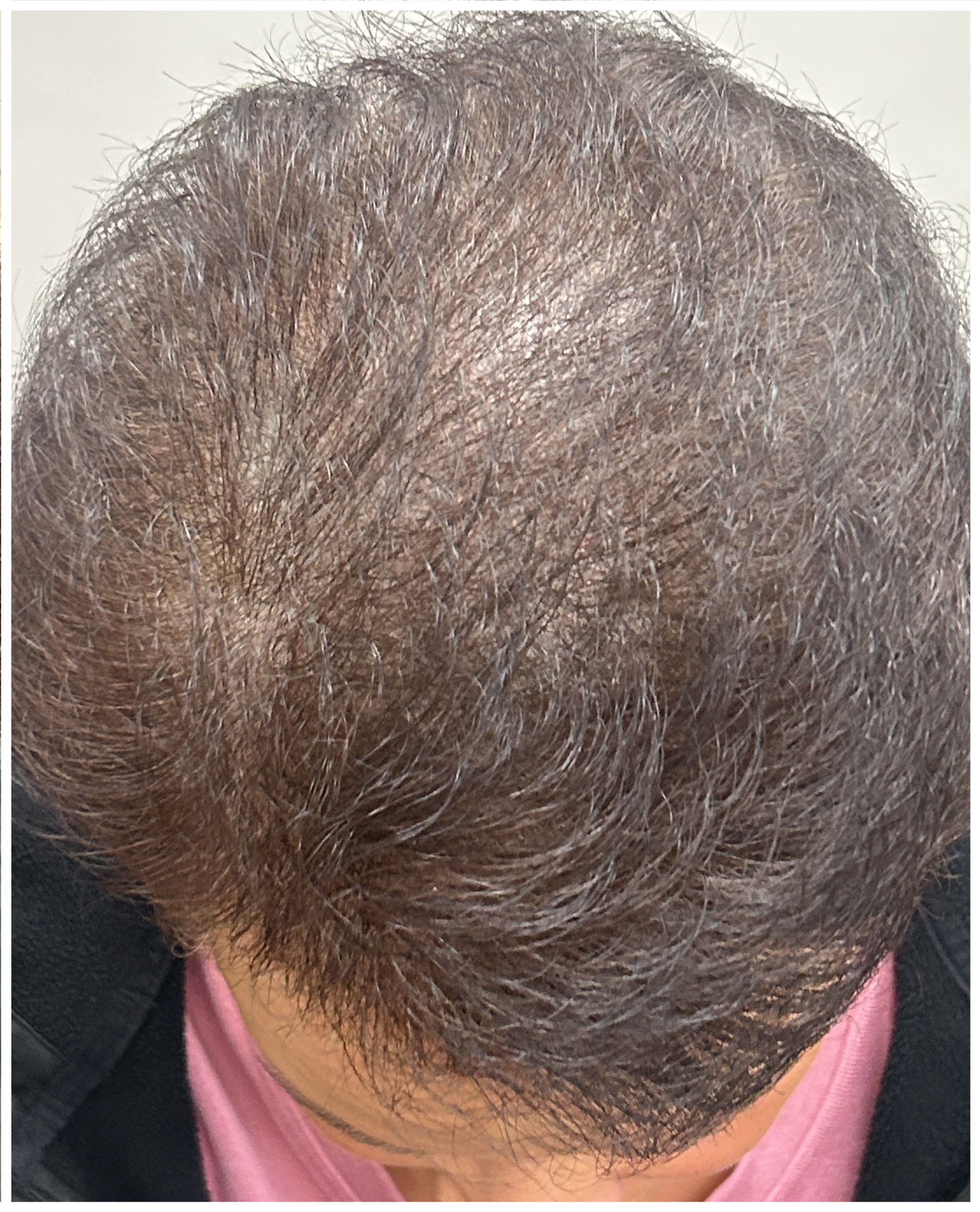 Exosome Hair Therapy after — Androgenetic Alopecia, Crown Thinning, Hair Density Loss, front view