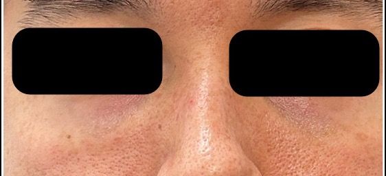 Candela PicoWay, Nd:YAG before — Enlarged Pores, Uneven Texture, Facial Redness, Skin Tone, front view
