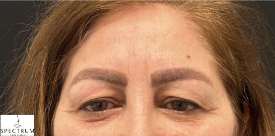 Botox before — Hooded Eyes, Low Brows, Forehead Heaviness, front view
