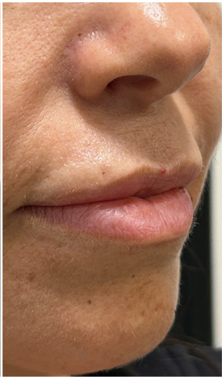 Lip Filler after — thin-lips, nasolabial-folds, front view