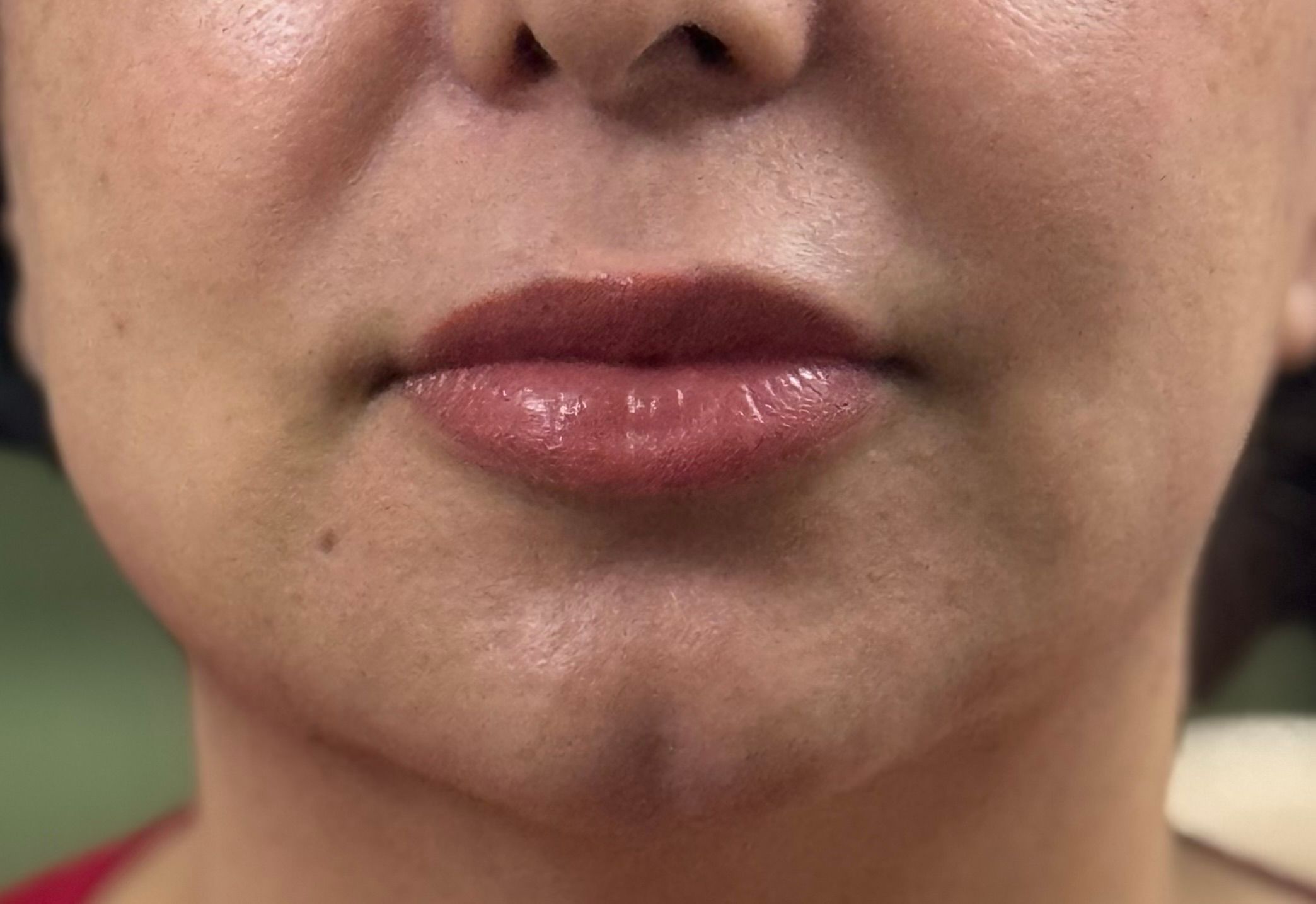 Lip Filler after — Thin Lips, front view