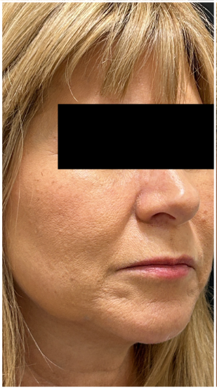 eMatrix Sublative before — Perioral Lines, Fine Lines and Wrinkles, Sagging and Laxity, Nasolabial Folds, Uneven Texture, front view