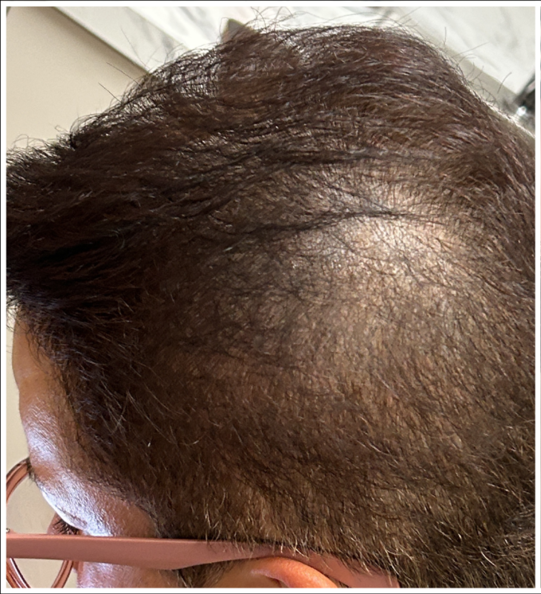 Exosome Hair Therapy before — Crown Thinning, Reduced Hair Density, Visible Scalp, front view