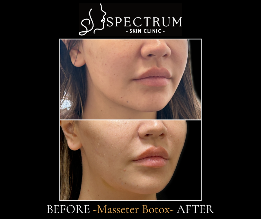 Masseter Botox Before & After | Lower Face Slimming and Jawline Softening