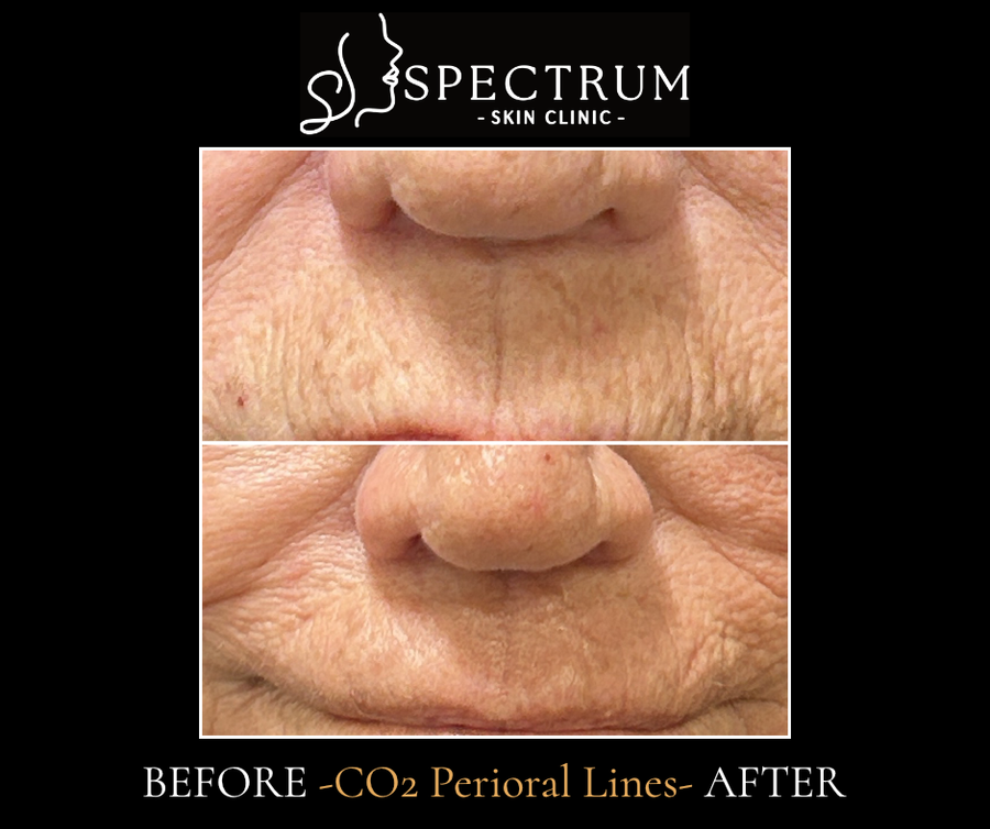 Frax CO2 Before and After | Perioral Line Resurfacing