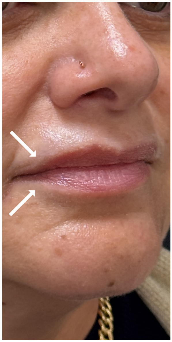 Lip Filler Dissolve before — Old migrated lip filler, loss of natural lip border, asymmetry, heaviness above the upper lip, undefined lip shape, unnatural appearance from previous filler, front view